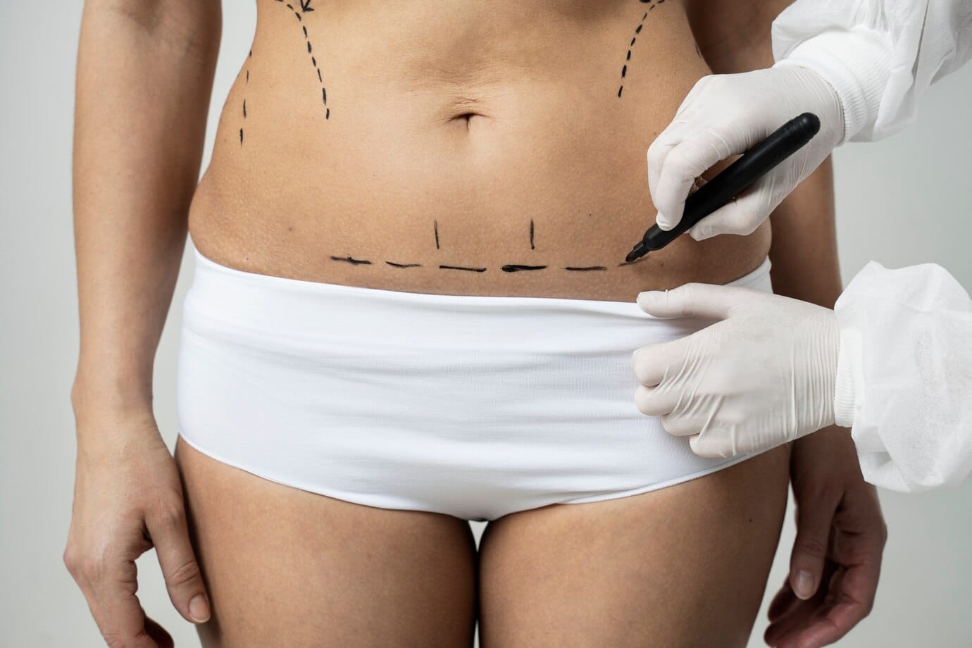 Este abdominoplastia o soluție pentru slăbit?
