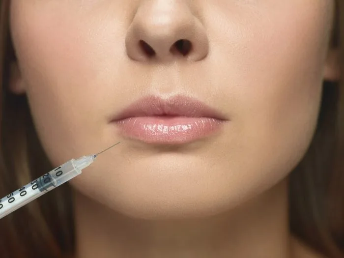 Butterfly Lips – Formă de buze cu acid hialuronic, echilibrată și feminină