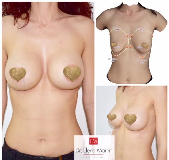 dr. elena martin: implant mamar