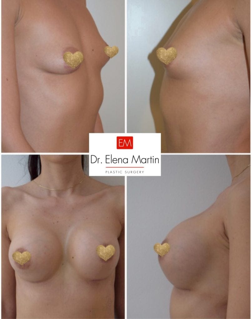 dr. elena martin: implant mamar
